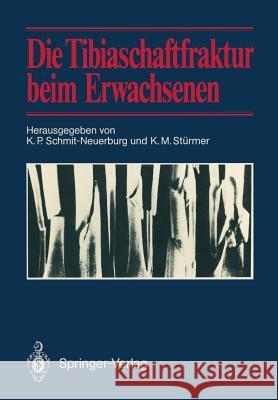 Die Tibiaschaftfraktur Beim Erwachsenen: Symposium Anläßlich Des 10jährigen Bestehens Der Abteilung Für Unfallchirurgie Am Klinikum Essen, 1./2. Febru Schmit-Neuerburg, K. P. 9783642715600