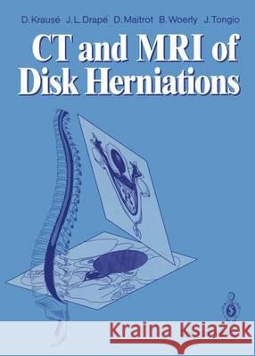 CT and MRI of Disk Herniations Denis Krause Jean L. Drape Daniel Maitrot 9783642735936