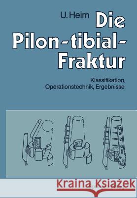 Die Pilon-Tibial-Fraktur: Klassifikation, Operationstechnik, Ergebnisse Allgöwer, M. 9783642759604 Springer