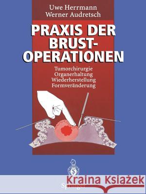 Praxis Der Brustoperationen: Tumorchirurgie -- Organerhaltung -- Wiederherstellung -- Formveränderung Herrmann, Uwe 9783642796098 Springer
