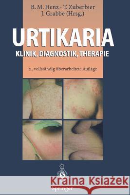 Urtikaria: Klinik, Diagnostik, Therapie Henz, Beate M. 9783642852428 Springer