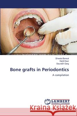 Bone grafts in Periodontics Shweta Bansal, Harjit Kaur, Saurabh Garg 9783659204890