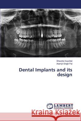 Dental Implants and Its Design Kaushal Shaveta 9783659592294 LAP Lambert Academic Publishing