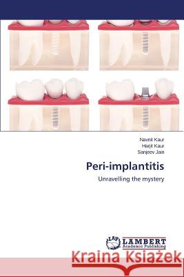 Peri-implantitis Kaur, Navnit 9783659744341 LAP Lambert Academic Publishing