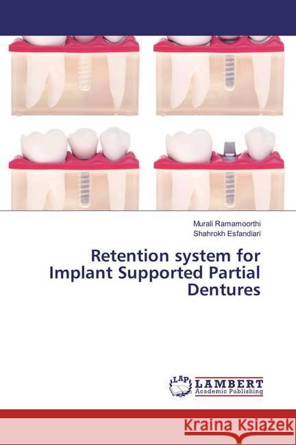 Retention system for Implant Supported Partial Dentures Ramamoorthi, Murali; Esfandiari, Shahrokh 9783659786310