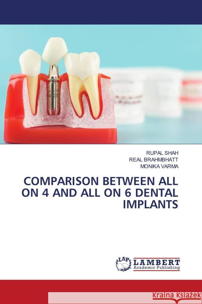 Comparison Between All on 4 and All on 6 Dental Implants Rupal Shah Real Brahmbhatt Monika Varma 9783659935022