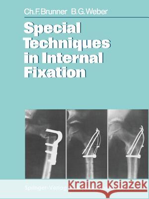 Special Techniques in Internal Fixation C. F. Brunner B. G. Weber T. C. Telger 9783662023471 Springer