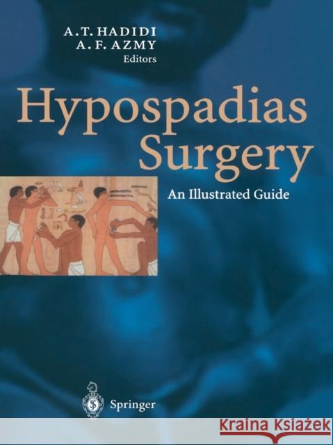 Hypospadias Surgery: An Illustrated Guide Hadidi, Ahmed 9783662078433