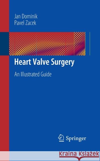 Heart Valve Surgery: An Illustrated Guide Dominik, Jan 9783662505717 Springer