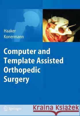 Computer and Template Assisted Orthopedic Surgery Rolf Haaker Werner Konermann 9783662510001 Springer