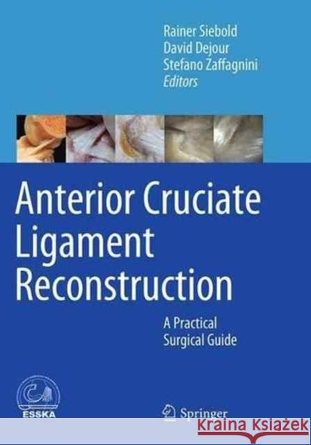 Anterior Cruciate Ligament Reconstruction: A Practical Surgical Guide Siebold, Rainer 9783662510834 Springer