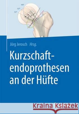 Kurzschaftendoprothesen an Der Hüfte Jerosch, Jörg 9783662527436