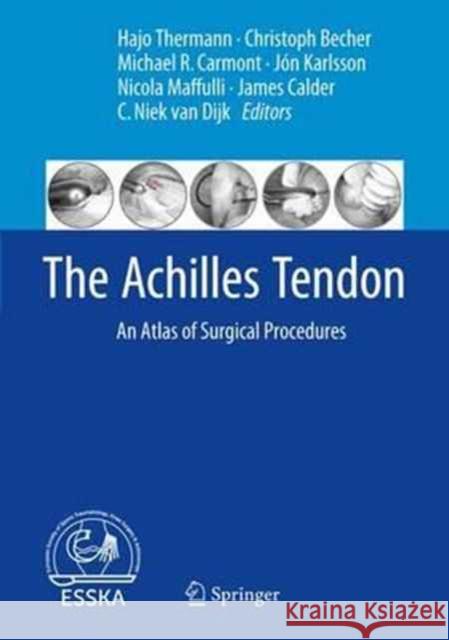 The Achilles Tendon: An Atlas of Surgical Procedures Thermann, Hajo 9783662540732 Springer