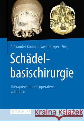 Schädelbasischirurgie: Therapiewahl Und Operatives Vorgehen König, Alexander 9783662546710 Springer, Berlin