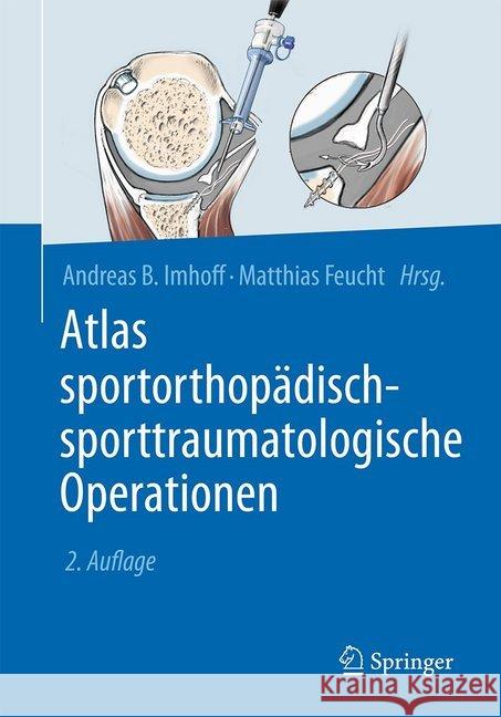 Atlas Sportorthopädisch-Sporttraumatologische Operationen Imhoff, Andreas B. 9783662548349 Springer