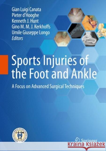Sports Injuries of the Foot and Ankle: A Focus on Advanced Surgical Techniques Canata, Gian Luigi 9783662587034 Springer