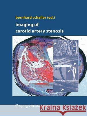 Imaging of Carotid Artery Stenosis Bernhard Schaller 9783709117415