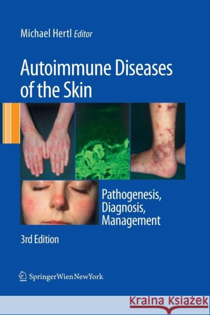 Autoimmune Diseases of the Skin: Pathogenesis, Diagnosis, Management Hertl, Michael 9783709119051 Springer
