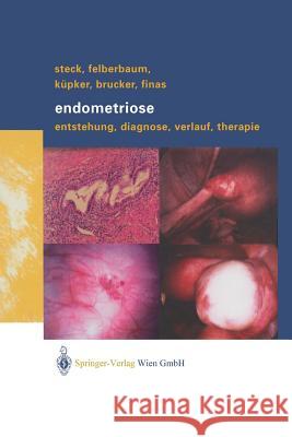 Endometriose: Entstehung, Diagnose, Verlauf Und Therapie Steck, Thomas 9783709171967 Springer