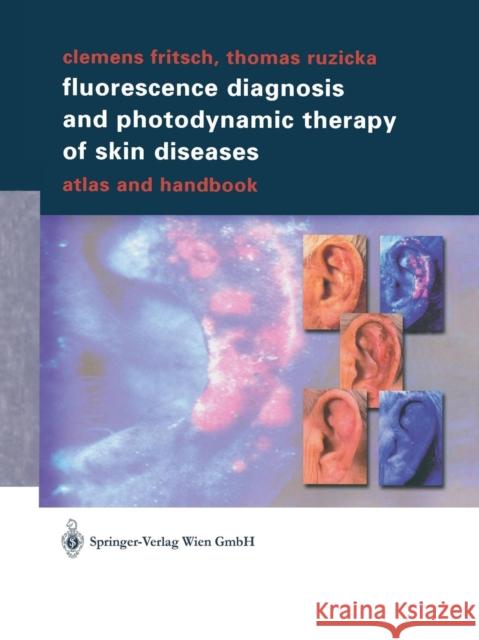 Fluorescence Diagnosis and Photodynamic Therapy of Skin Diseases: Atlas and Handbook Fritsch, Clemens 9783709172933