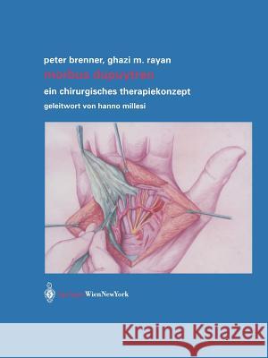Morbus Dupuytren: Ein Chirurgisches Therapiekonzept Brenner, Peter 9783709173923 Springer