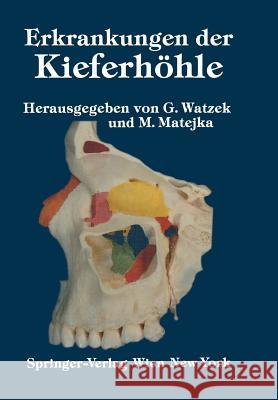 Erkrankungen Der Kieferhöhle: Symposium, Fuschl, 26.-29. September 1985 Watzek, G. 9783709188347 Springer