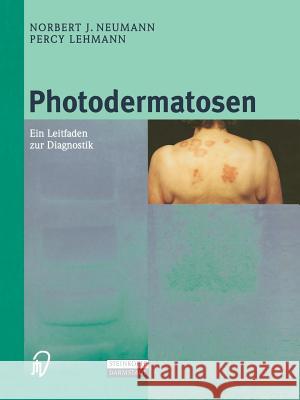 Photodermatosen: Ein Leitfaden Zur Diagnostik N. J. Neumann Percy Lehmann 9783798512290 Steinkopff-Verlag Darmstadt