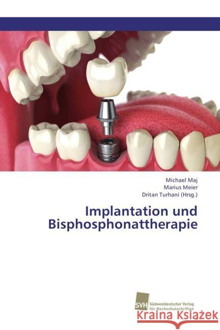 Implantation und Bisphosphonattherapie Maj, Michael; Meier, Marius 9783838138886