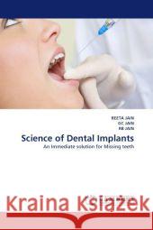 Science of Dental Implants Reeta Jain, Gc Jain, Rb Jain 9783844321289