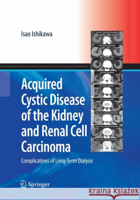 Acquired Cystic Disease of the Kidney and Renal Cell Carcinoma: Complication of Long-Term Dialysis Ishikawa, Isao 9784431563198 Springer