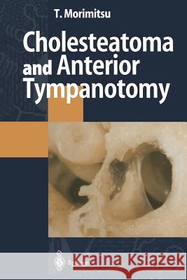 Cholesteatoma and Anterior Tympanotomy Tamotsu Morimitsu 9784431684411 Springer