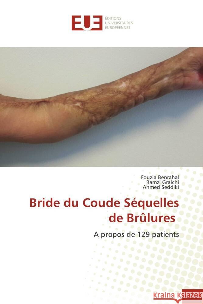 Bride du Coude Séquelles de Brûlures Benrahal, Fouzia, Graichi, Ramzi, Seddiki, Ahmed 9786138458135