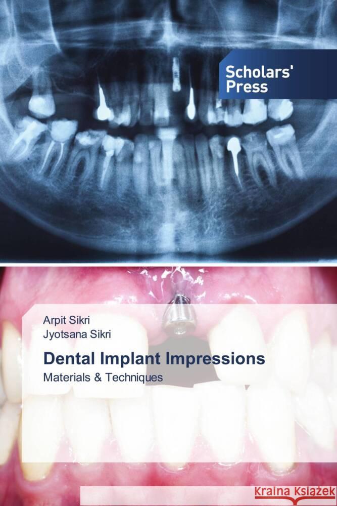 Dental Implant Impressions Sikri, Arpit, Sikri, Jyotsana 9786138967057