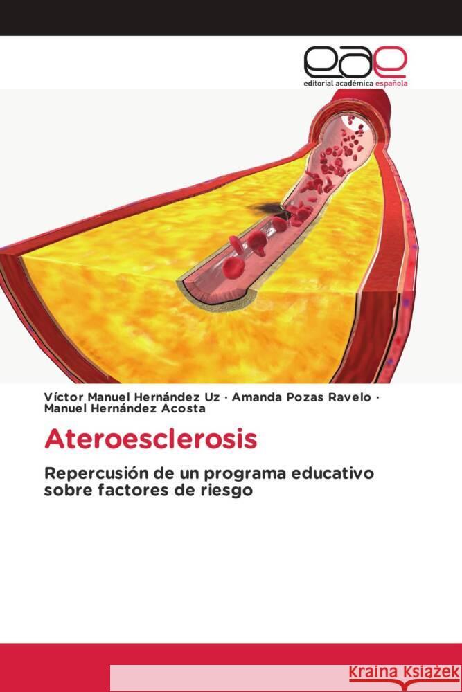 Ateroesclerosis V?ctor Manuel Hern?nde Amanda Poza Manuel Hern?nde 9786138984900 Editorial Academica Espanola