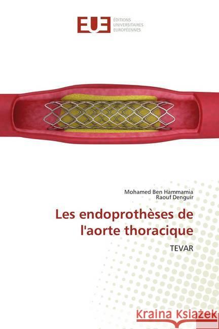 Les endoprothèses de l'aorte thoracique : TEVAR Ben Hammamia, Mohamed; Denguir, Raouf 9786139520541