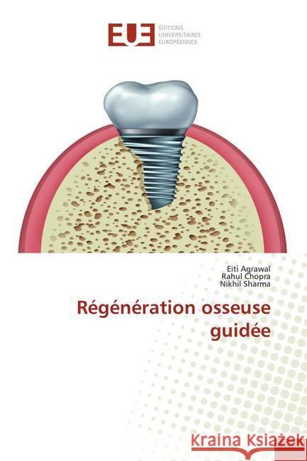 Régénération osseuse guidée Agrawal, Eiti; Chopra, Rahul; Sharma, Nikhil 9786139552849 Éditions universitaires européennes
