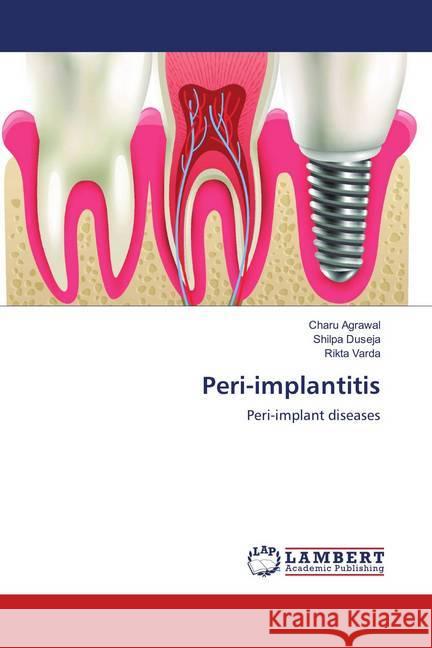 Peri-implantitis : Peri-implant diseases Agrawal, Charu; Duseja, Shilpa; Varda, Rikta 9786139915781 LAP Lambert Academic Publishing