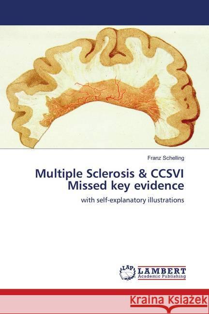 Multiple Sclerosis & CCSVI Missed key evidence : with self-explanatory illustrations Schelling, Franz 9786139920563 LAP Lambert Academic Publishing