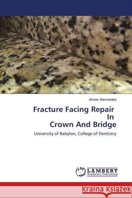 Fracture Facing Repair In Crown And Bridge : University of Babylon, College of Dentistry Alameedee, Ameer 9786139982424