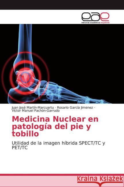 Medicina Nuclear en patología del pie y tobillo : Utilidad de la imagen híbrida SPECT/TC y PET/TC Martín-Marcuartu, Juan José; García Jiménez, Rosario; Pachón-Garrudo, Víctor Manuel 9786200030023