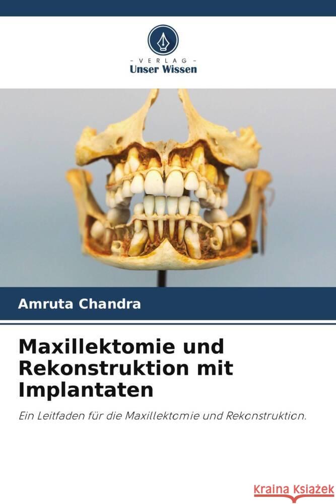 Maxillektomie und Rekonstruktion mit Implantaten Chandra, Amruta 9786200080318