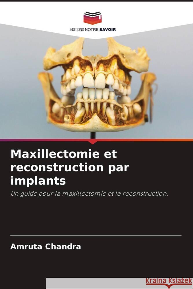 Maxillectomie et reconstruction par implants Chandra, Amruta 9786200083487