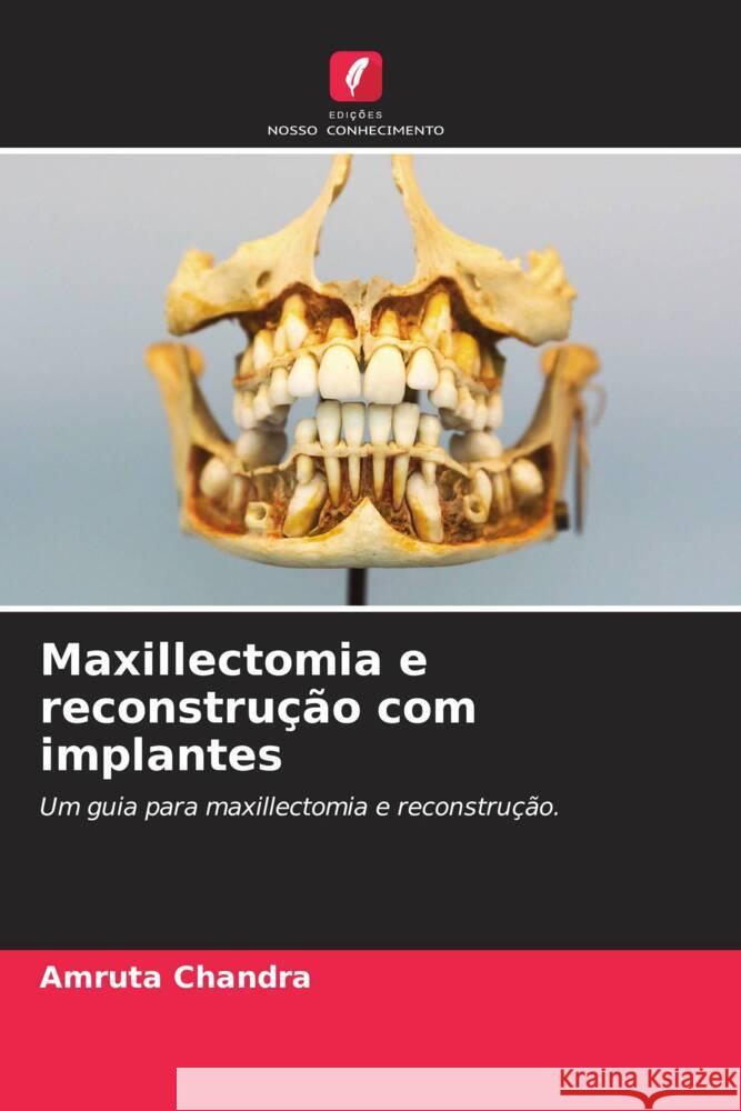 Maxillectomia e reconstrução com implantes Chandra, Amruta 9786200084514