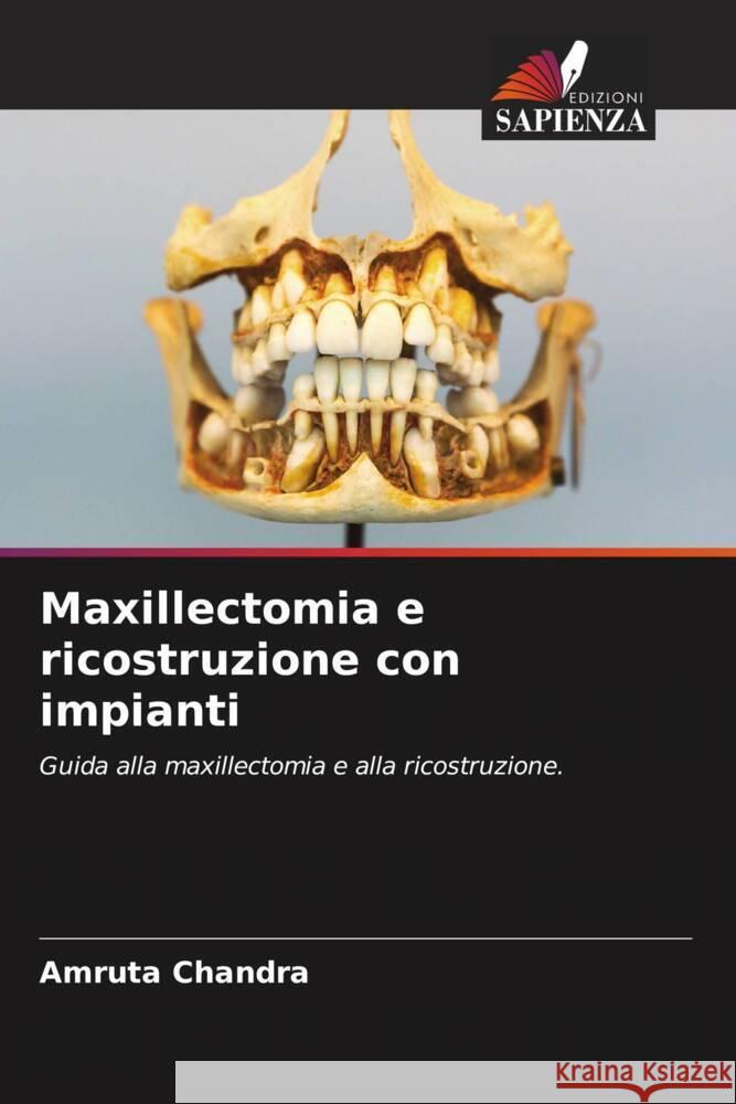 Maxillectomia e ricostruzione con impianti Chandra, Amruta 9786200092243