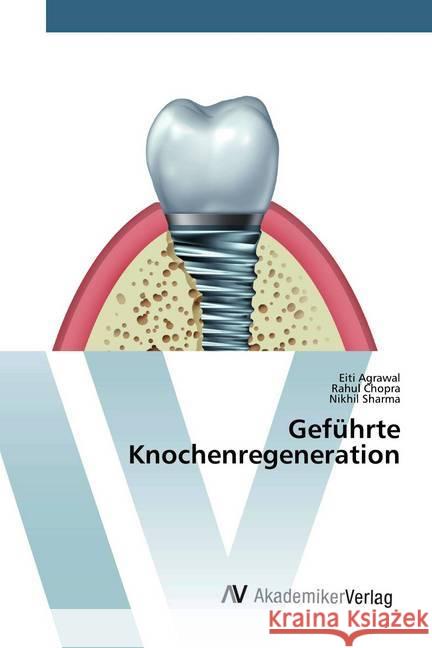 Geführte Knochenregeneration Agrawal, Eiti; Chopra, Rahul; Sharma, Nikhil 9786200099181 AV Akademikerverlag