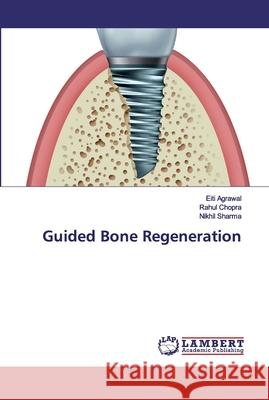 Guided Bone Regeneration Agrawal, Eiti; Chopra, Rahul; Sharma, Nikhil 9786200261212
