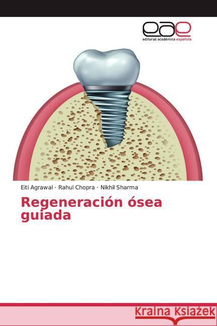 Regeneración ósea guiada Agrawal, Eiti; Chopra, Rahul; Sharma, Nikhil 9786200379719 Editorial Académica Española