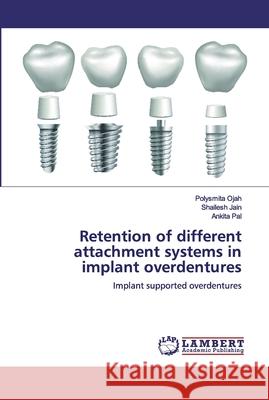 Retention of different attachment systems in implant overdentures Ojah, Polysmita 9786200474292 LAP Lambert Academic Publishing