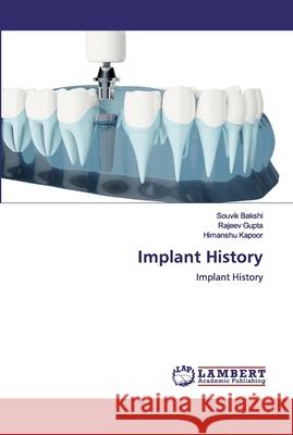 Implant History Bakshi, Souvik 9786200486967 LAP Lambert Academic Publishing