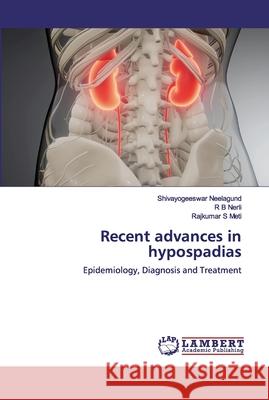 Recent advances in hypospadias Neelagund, Shivayogeeswar 9786200536808 LAP Lambert Academic Publishing